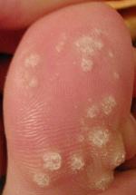 wart treatment